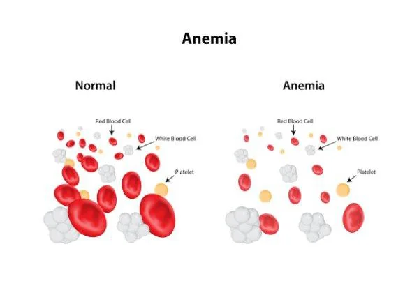 Anemia and Thalassemia Check